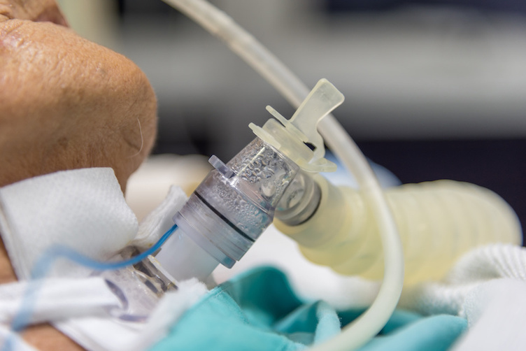 Patient do tracheostomy and ventilator in hospital